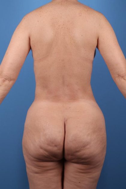 Vaser Liposuction Before & After Image