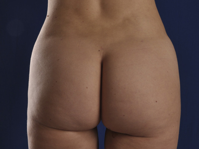 Vaser Liposuction Before & After Image