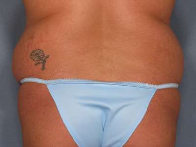 Vaser Liposuction Before & After Image