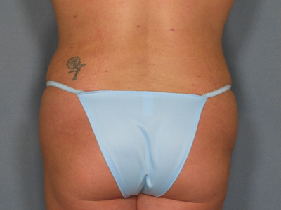 Vaser Liposuction Before & After Image