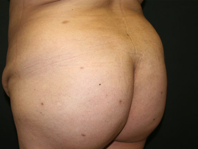 Vaser Liposuction Before & After Image