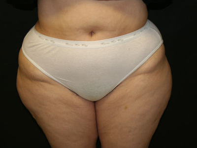 Vaser Liposuction Before & After Image