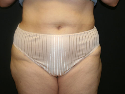 Vaser Liposuction Before & After Image