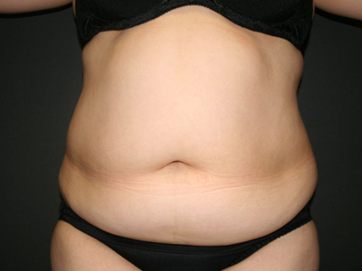 Vaser Liposuction Before & After Image