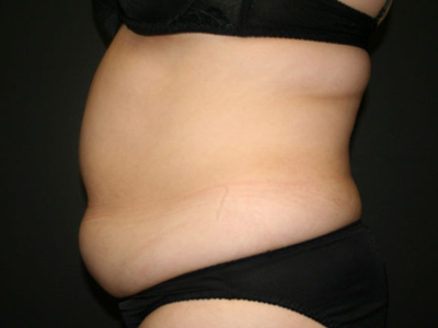 Vaser Liposuction Before & After Image