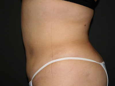 Vaser Liposuction Before & After Image