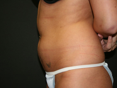 Vaser Liposuction Before & After Image