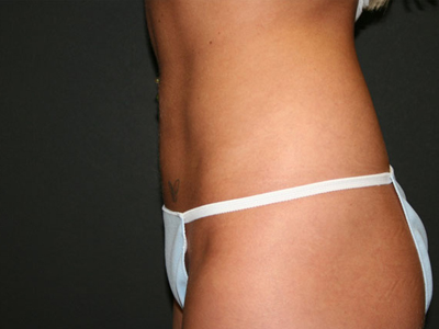 Vaser Liposuction Before & After Image