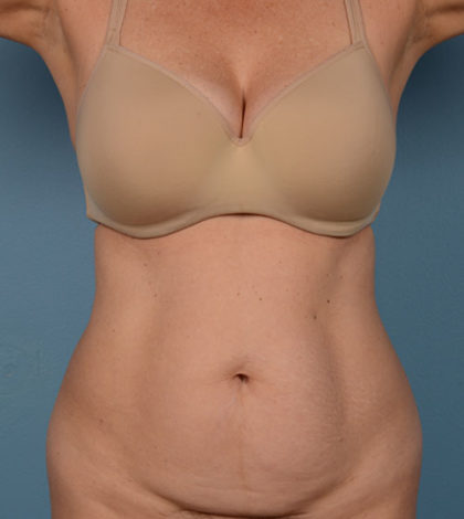 Vaser Liposuction Before & After Image