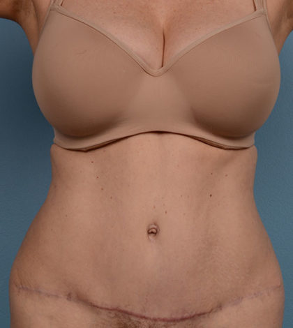 Vaser Liposuction Before & After Image