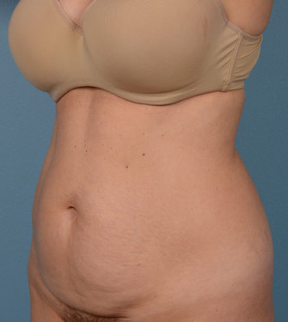 Vaser Liposuction Before & After Image