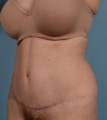 Vaser Liposuction Before & After Image