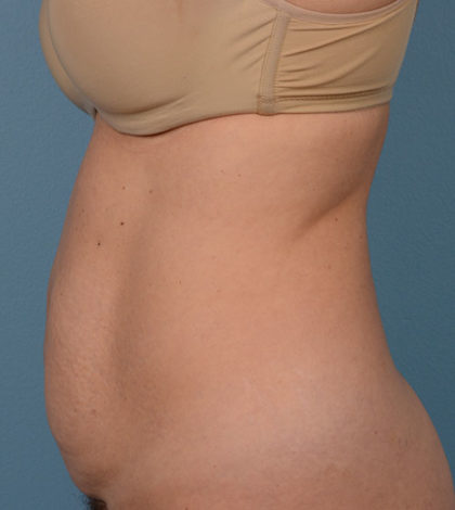 Vaser Liposuction Before & After Image