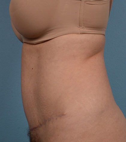 Vaser Liposuction Before & After Image