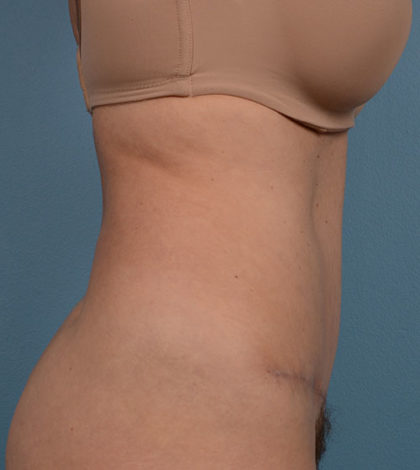 Vaser Liposuction Before & After Image