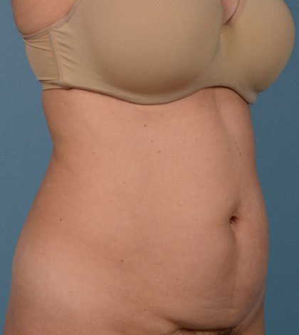 Vaser Liposuction Before & After Image