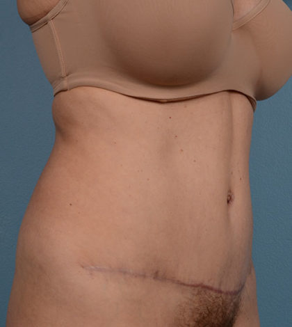 Vaser Liposuction Before & After Image