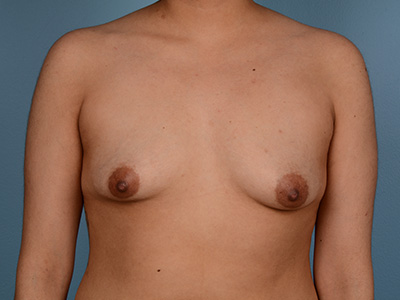 Breast Augmentation Before & After Image