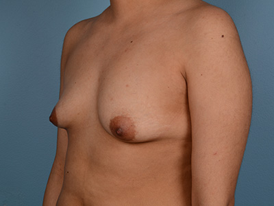 Breast Augmentation Before & After Image