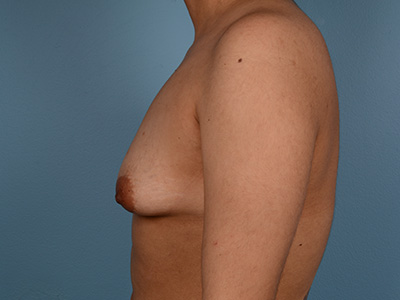 Breast Augmentation Before & After Image