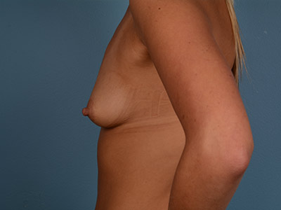 Breast Augmentation Before & After Image