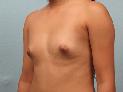 Breast Augmentation Before & After Image