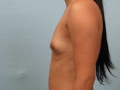 Breast Augmentation Before & After Image