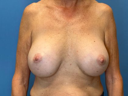 Breast Implant Replacement Before & After Image