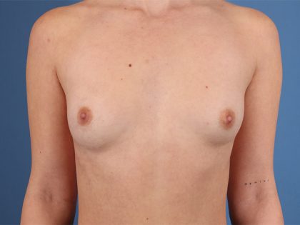 Breast Implant Replacement Before & After Image