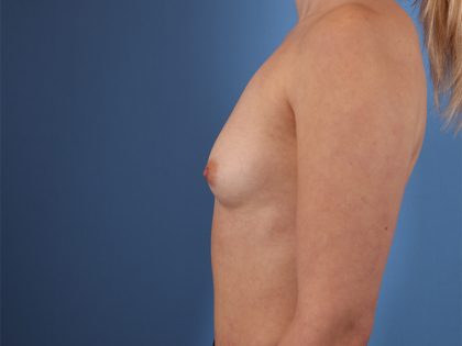 Breast Implant Replacement Before & After Image