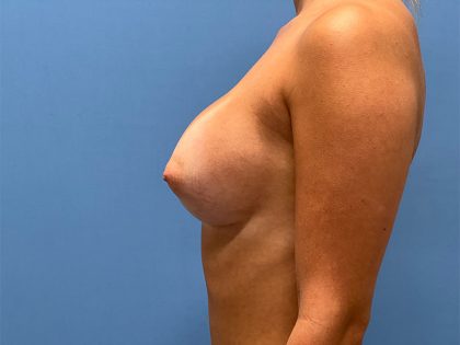 Breast Implant Replacement Before & After Image