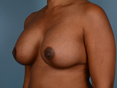 Breast Augmentation With Lift Before & After Image