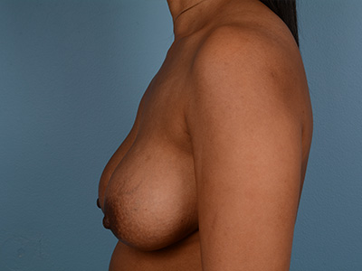 Breast Augmentation With Lift Before & After Image