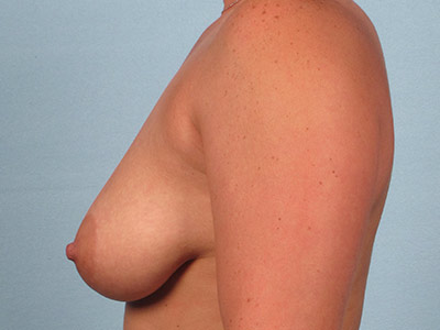 Breast Augmentation With Lift Before & After Image