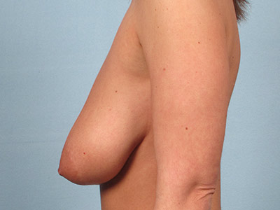 Breast Augmentation With Lift Before & After Image