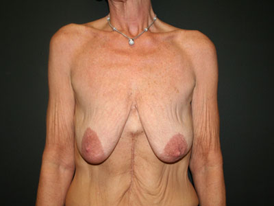 Breast Augmentation With Lift Before & After Image