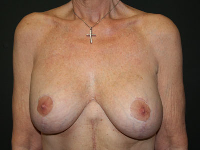 Breast Augmentation With Lift Before & After Image