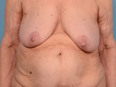 Breast Augmentation With Lift Before & After Image