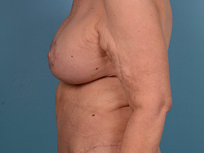 Breast Augmentation With Lift Before & After Image