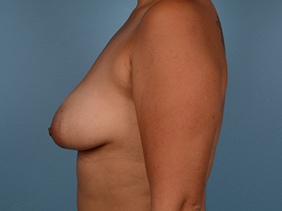 Breast Augmentation With Lift Before & After Image