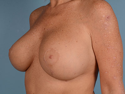 Breast Augmentation With Lift Before & After Image