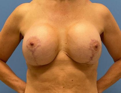 Breast Augmentation With Lift Before & After Image