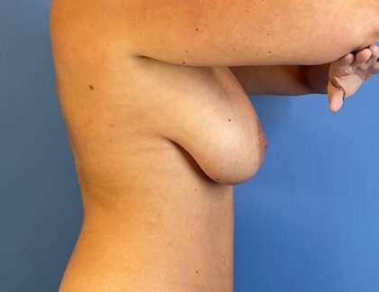 Breast Augmentation With Lift Before & After Image