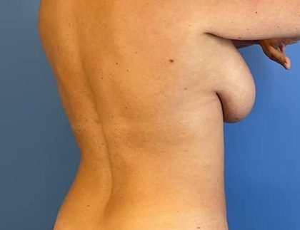 Breast Augmentation With Lift Before & After Image