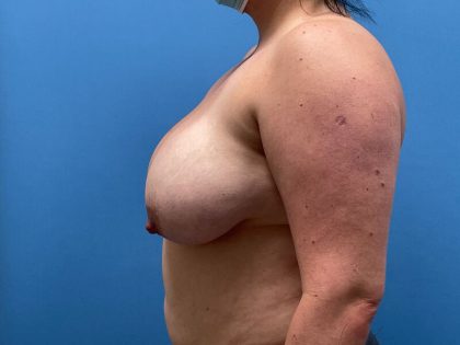 Breast Lift Before & After Image