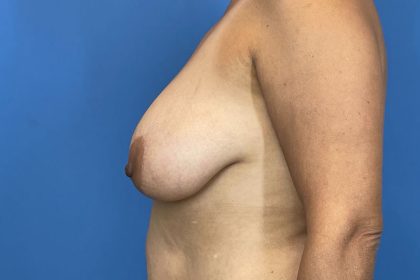 Breast Lift Before & After Image