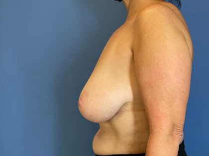 Breast Lift Before & After Image