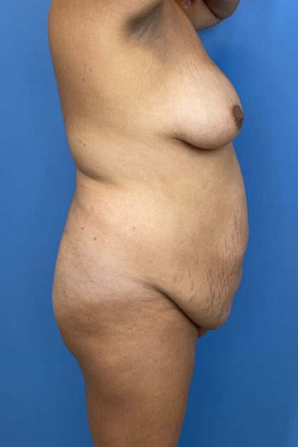 Breast Lift Before & After Image