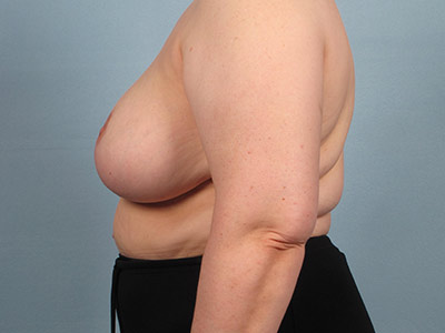 Breast Reduction Before & After Image