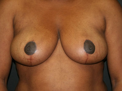 Breast Reduction Before & After Image